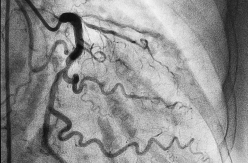 Robotic Total Arterial Midcab For Coronary Revascularization Penn